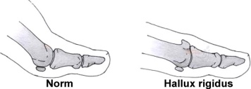 hallux-rigidus-diagram